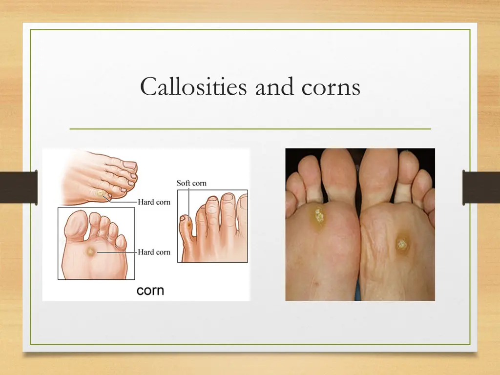 callosities and corns