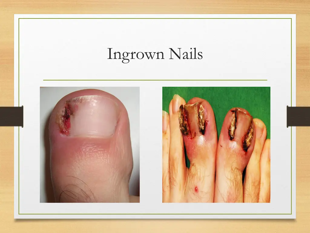 ingrown nails