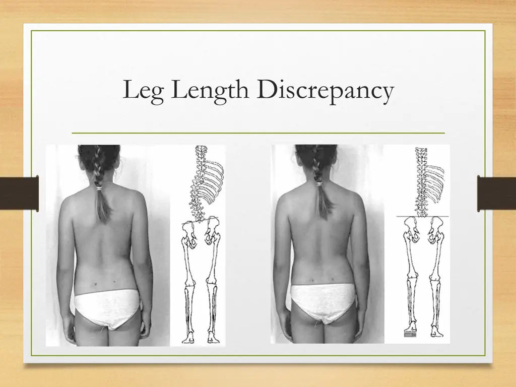 leg length discrepancy