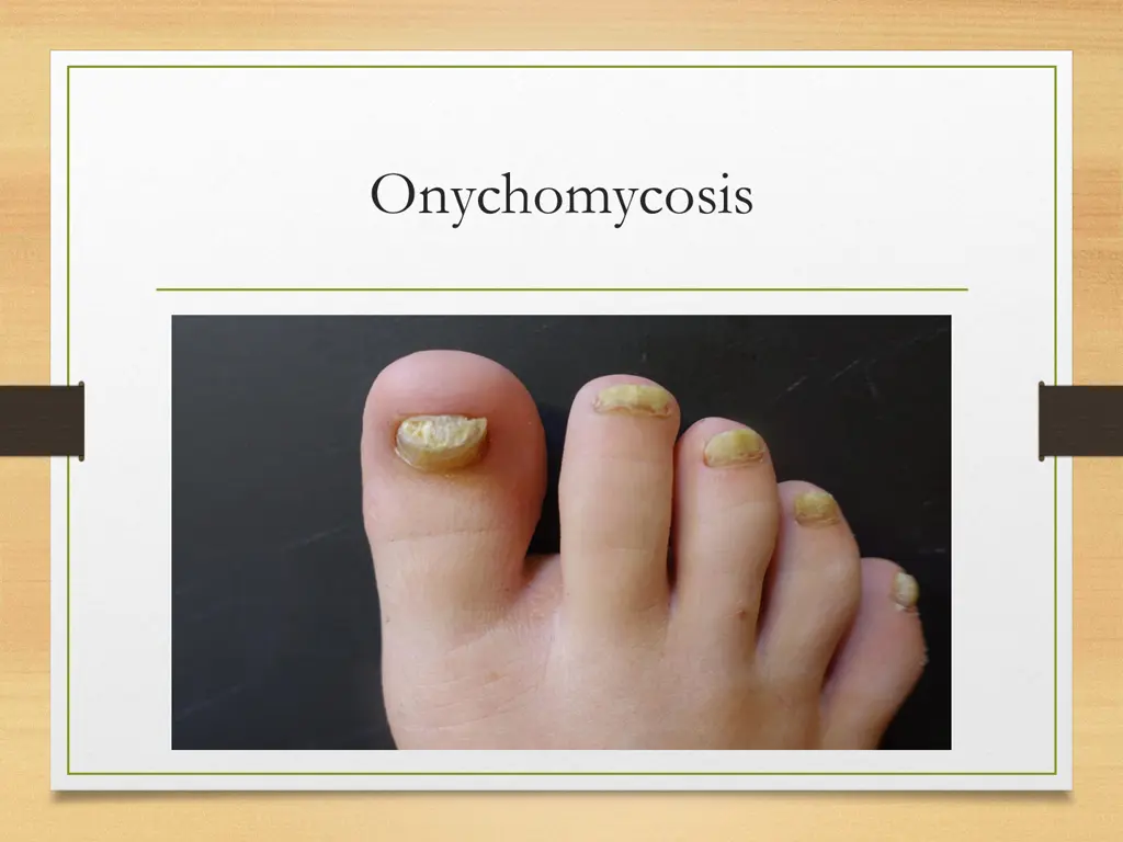 onychomycosis