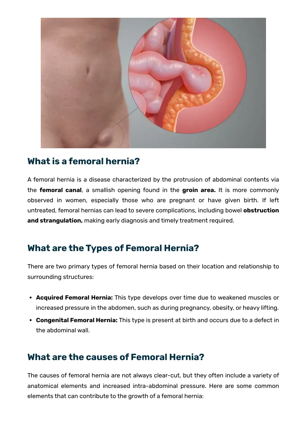 what is a femoral hernia