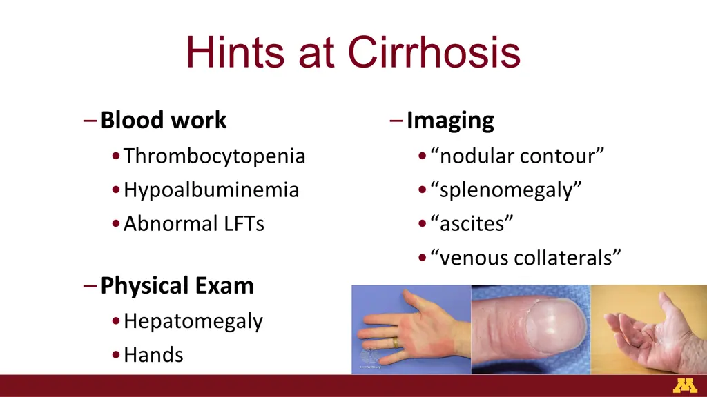 hints at cirrhosis