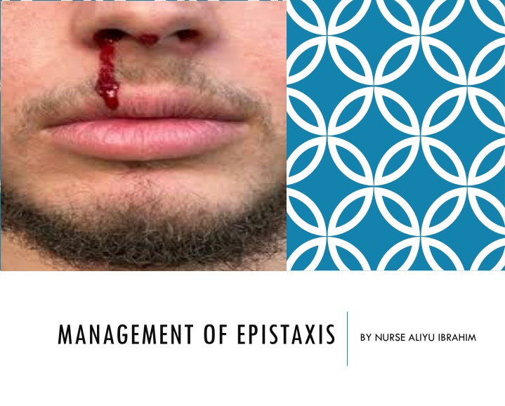 management of epistaxis