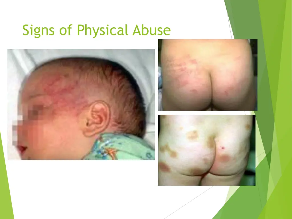 signs of physical abuse
