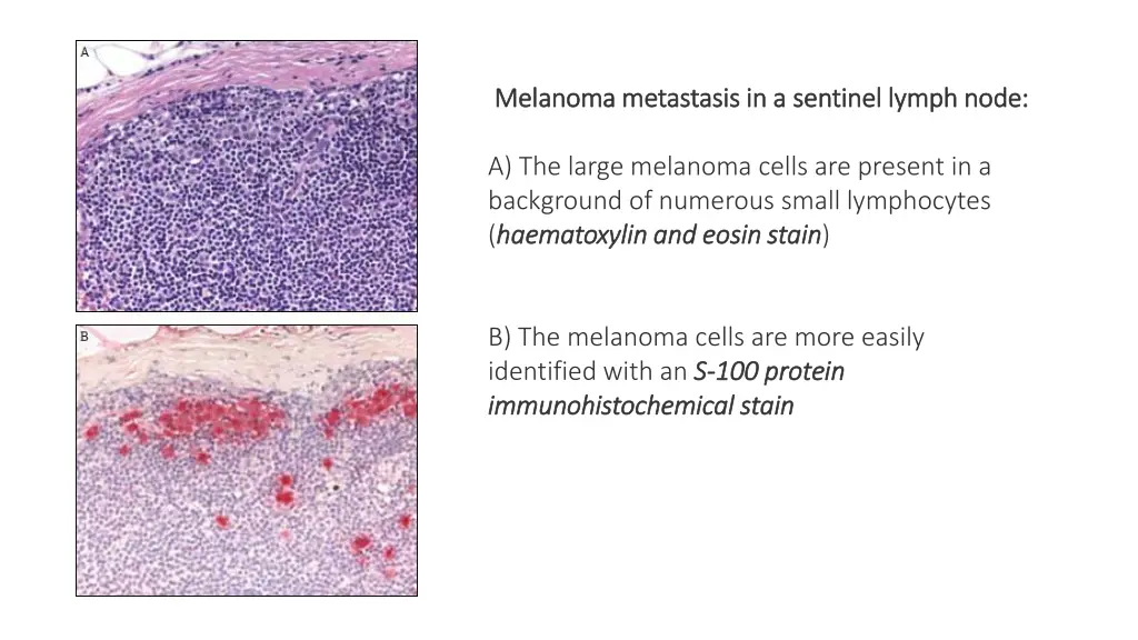 melanoma metastasis in a sentinel lymph node