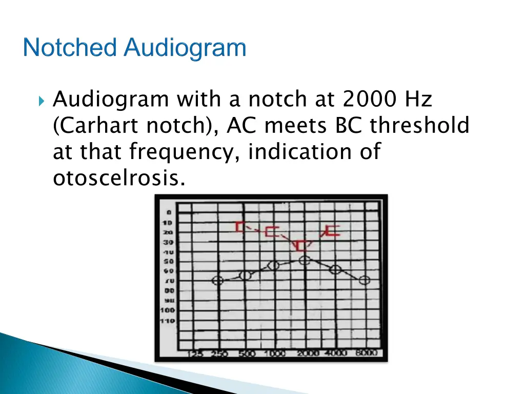 audiogram with a notch at 2000 hz carhart notch