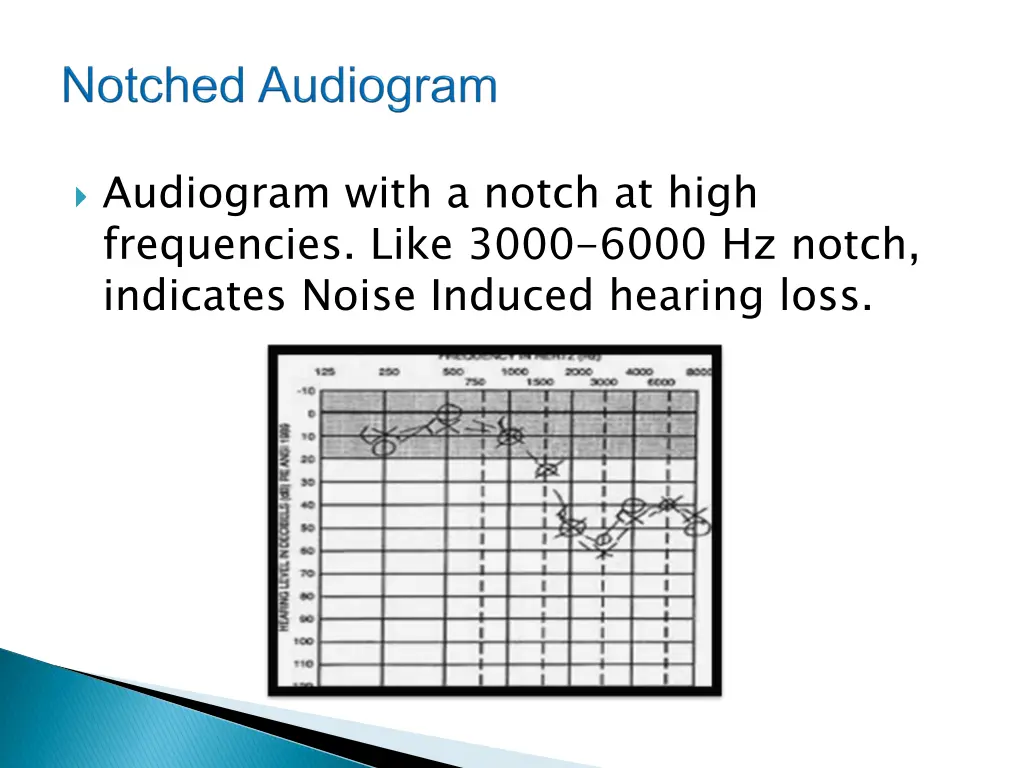 audiogram with a notch at high frequencies like