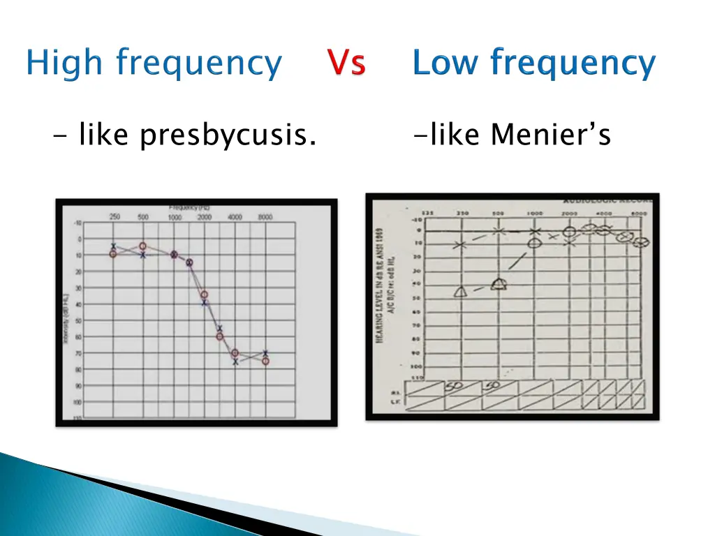 like presbycusis like menier s