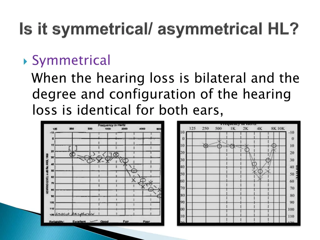 symmetrical when the hearing loss is bilateral