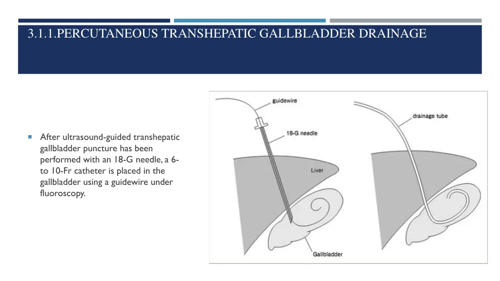 3 1 1 percutaneous transhepatic gallbladder