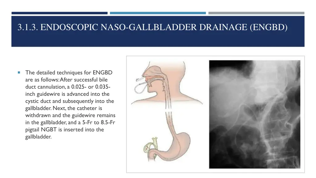 3 1 3 endoscopic naso gallbladder drainage engbd