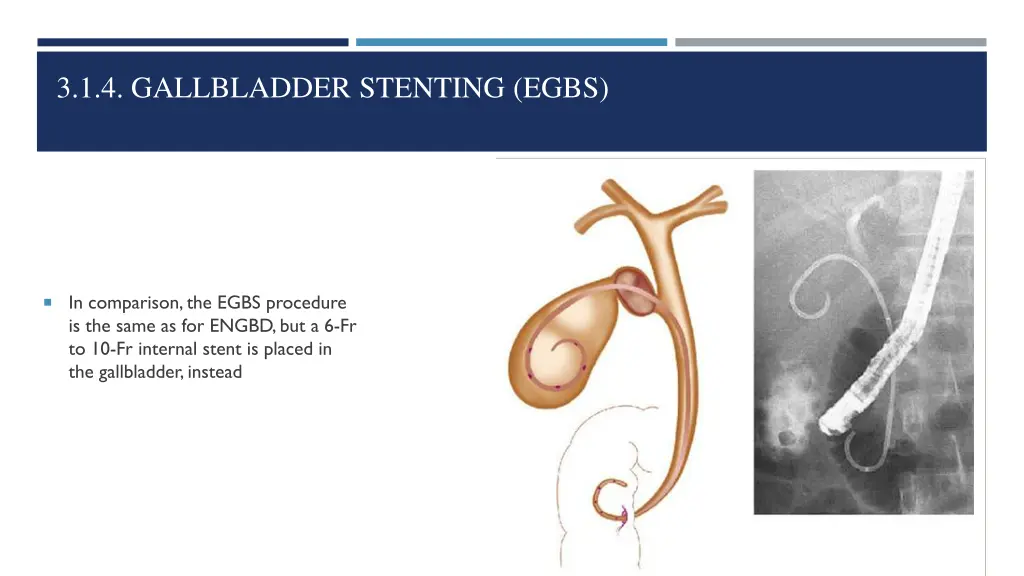 3 1 4 gallbladder stenting egbs