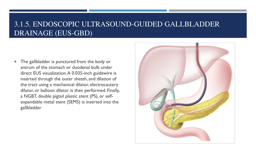 3 1 5 endoscopic ultrasound guided gallbladder