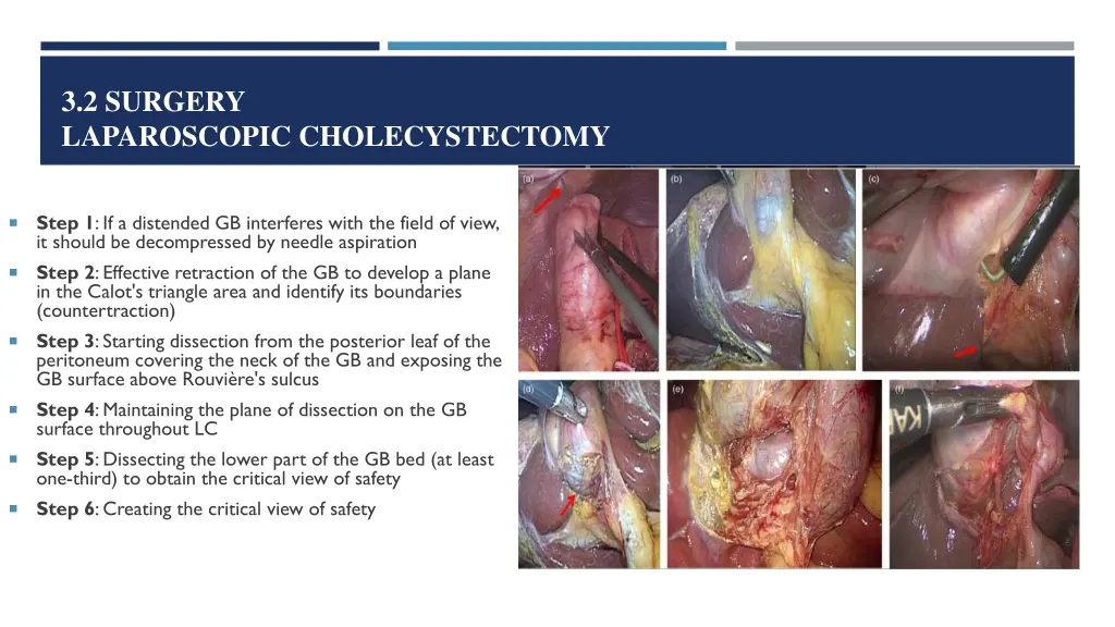 3 2 surgery laparoscopic cholecystectomy