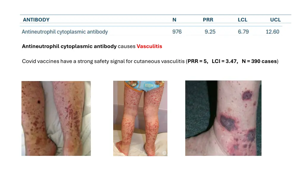 antineutrophil cytoplasmic antibody causes