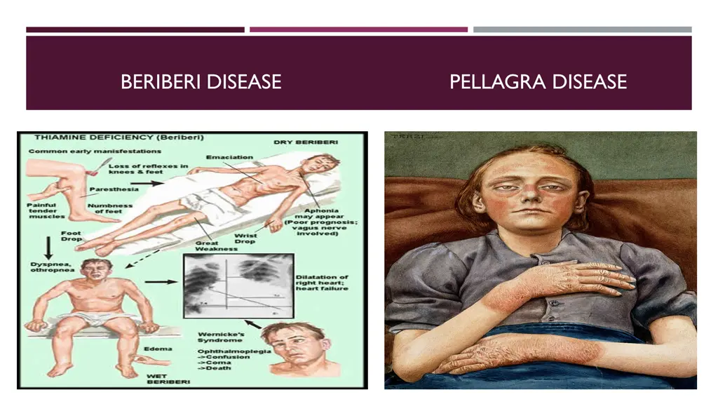 beriberi disease