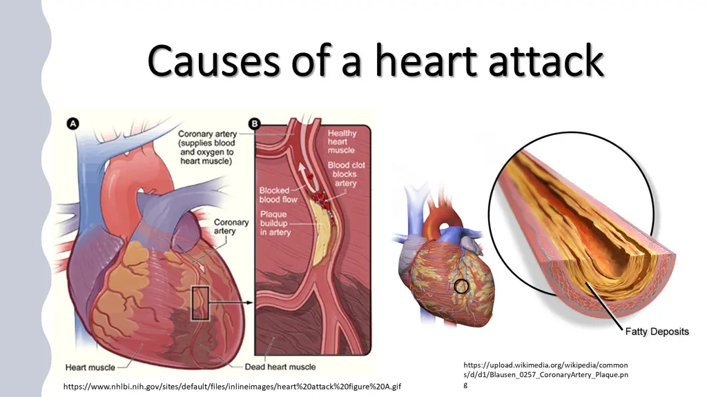 causes of a heart attack causes of a heart attack