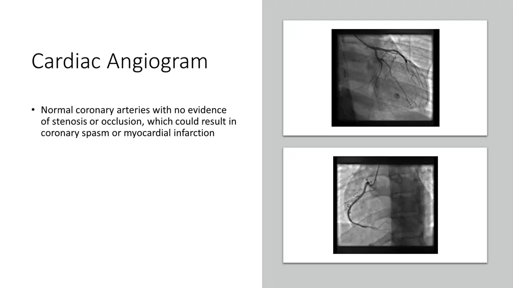 cardiac angiogram