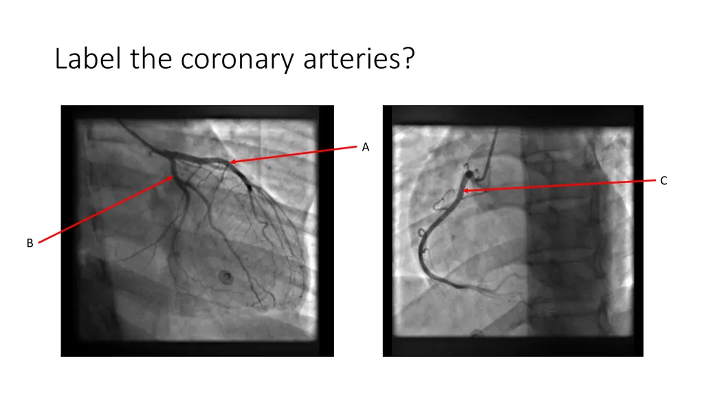label the coronary arteries