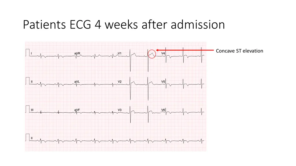 patients ecg 4 weeks after admission