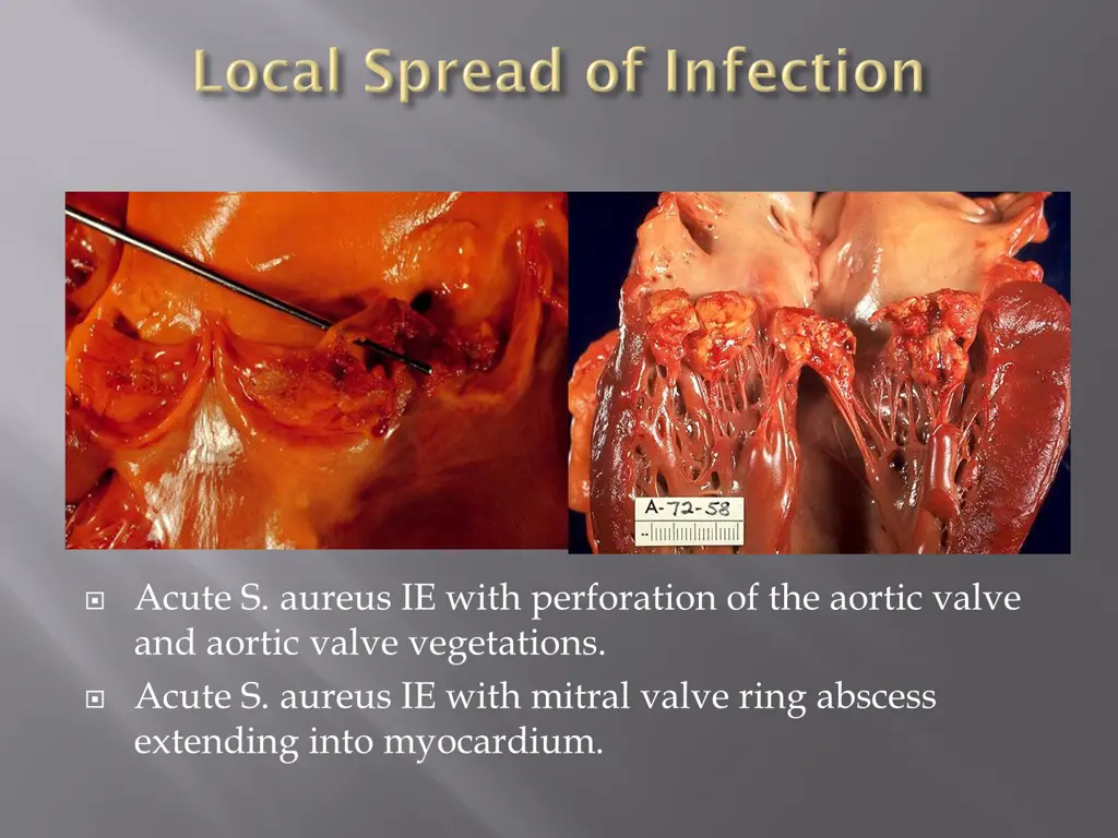 acute s aureus ie with perforation of the aortic