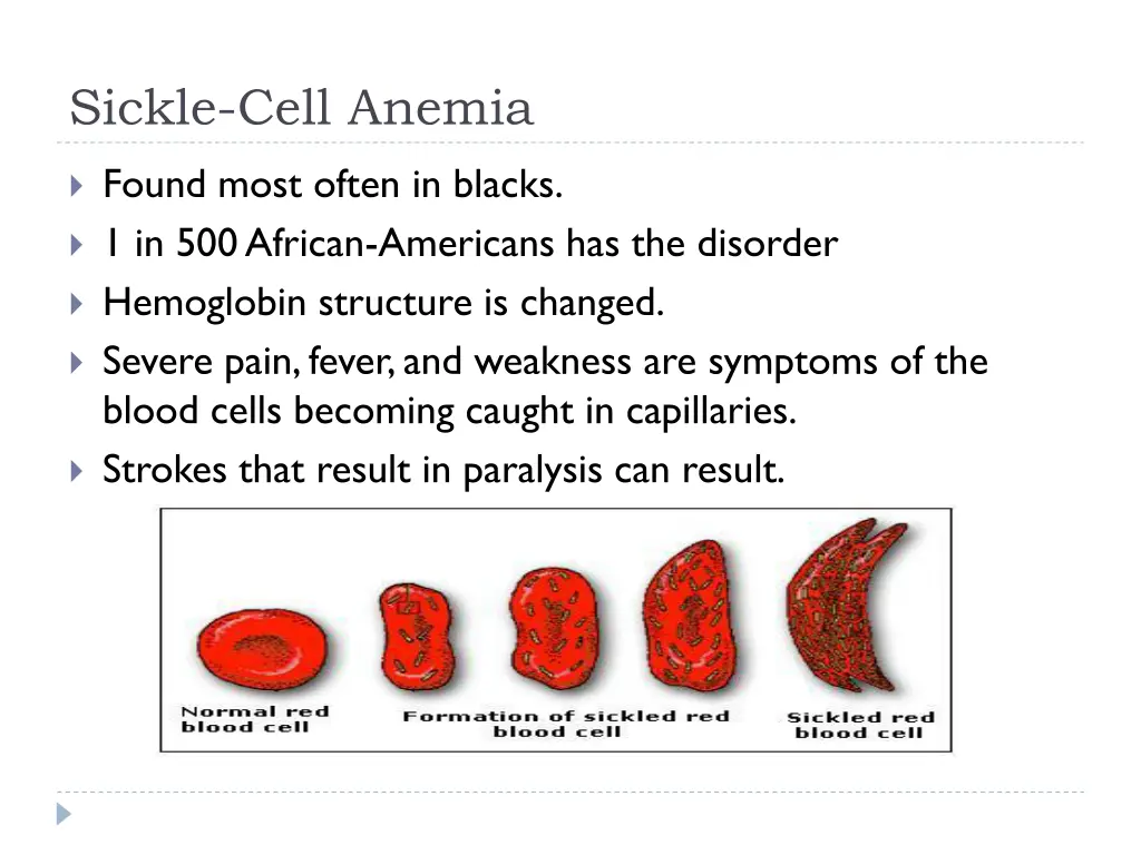 sickle cell anemia