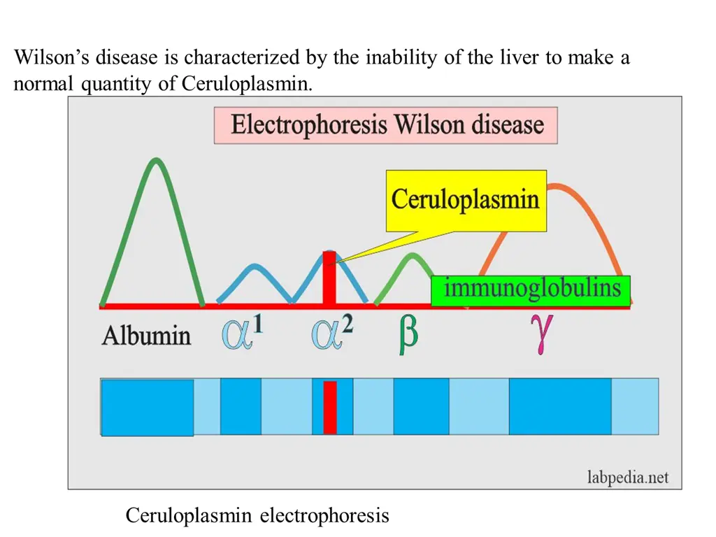 wilson s disease is characterized