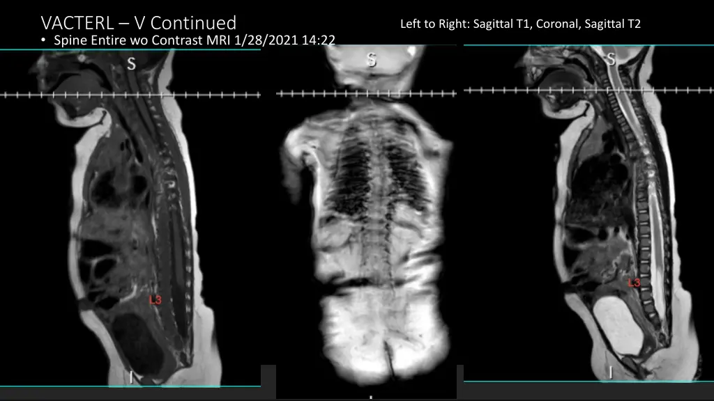 vacterl v continued spine entire wo contrast