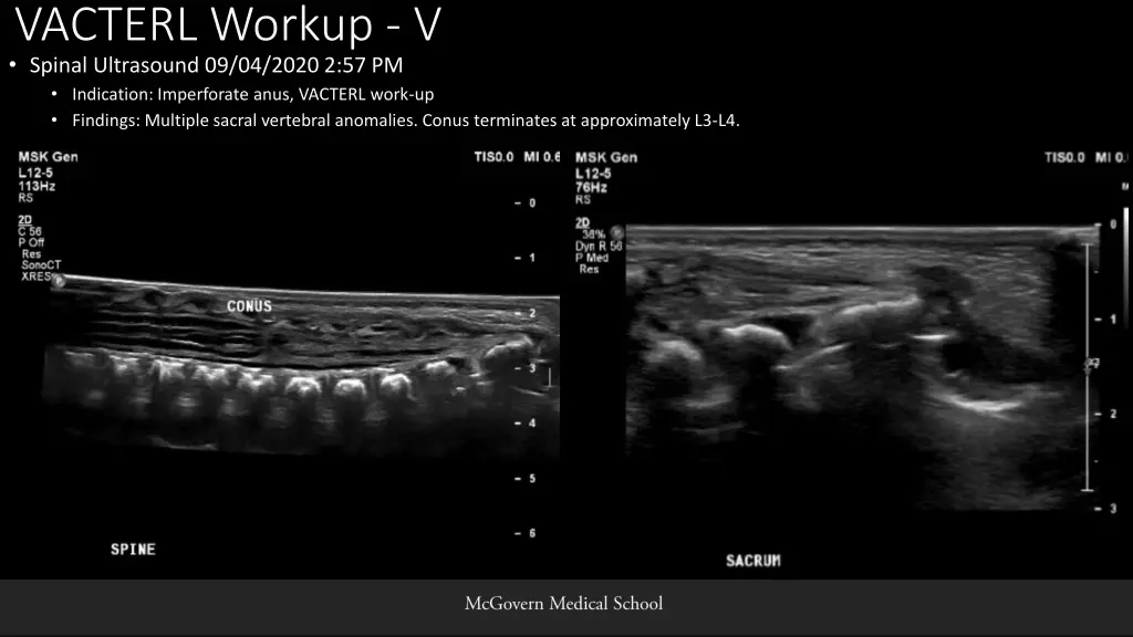 vacterl workup v spinal ultrasound 09 04 2020