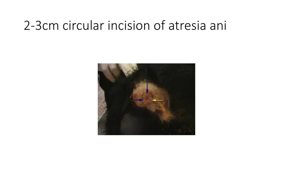 2 3cm circular incision of atresia ani