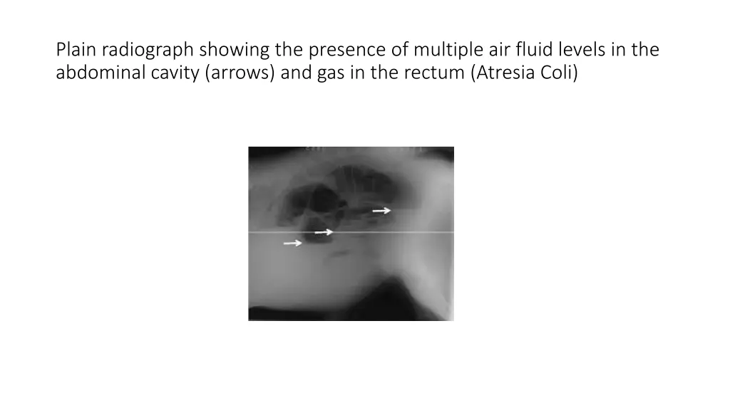 plain radiograph showing the presence of multiple