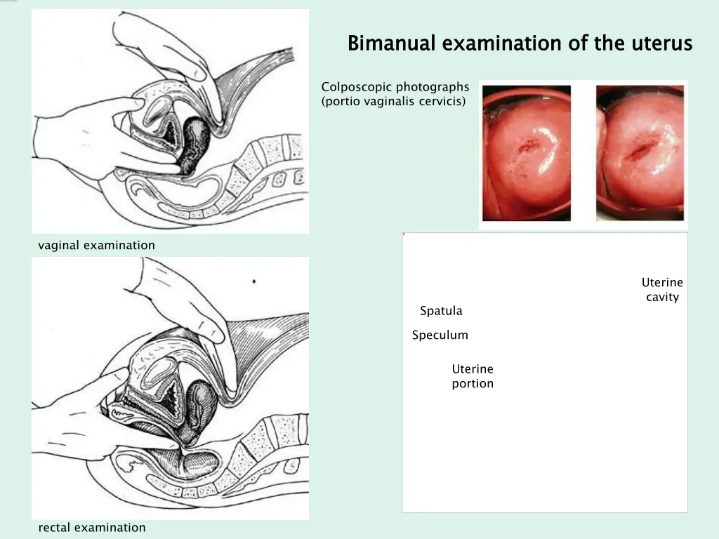 bimanual examination of the uterus