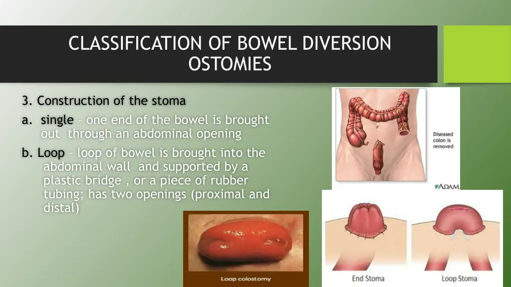 classification of bowel diversion ostomies 3