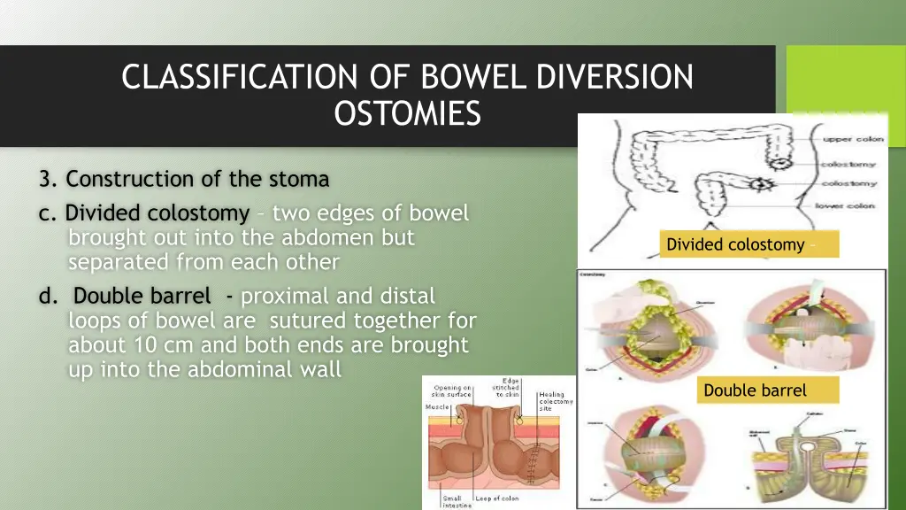 classification of bowel diversion ostomies 4