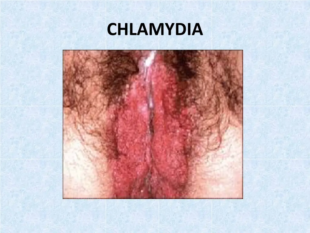 chlamydia 1