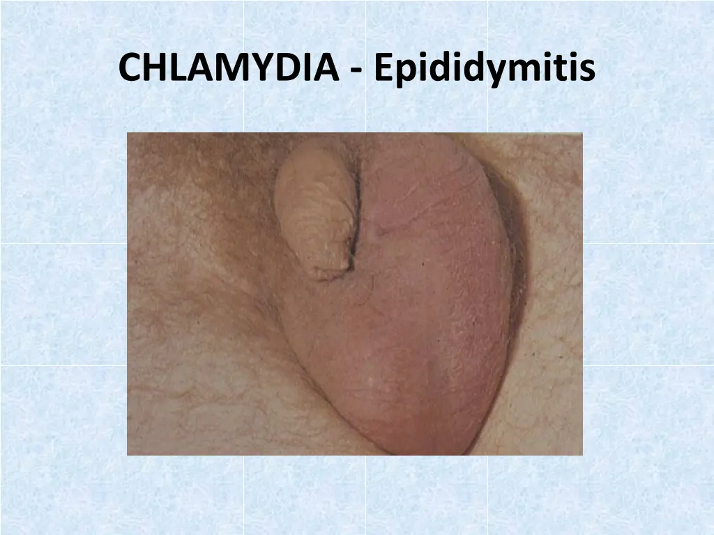 chlamydia epididymitis