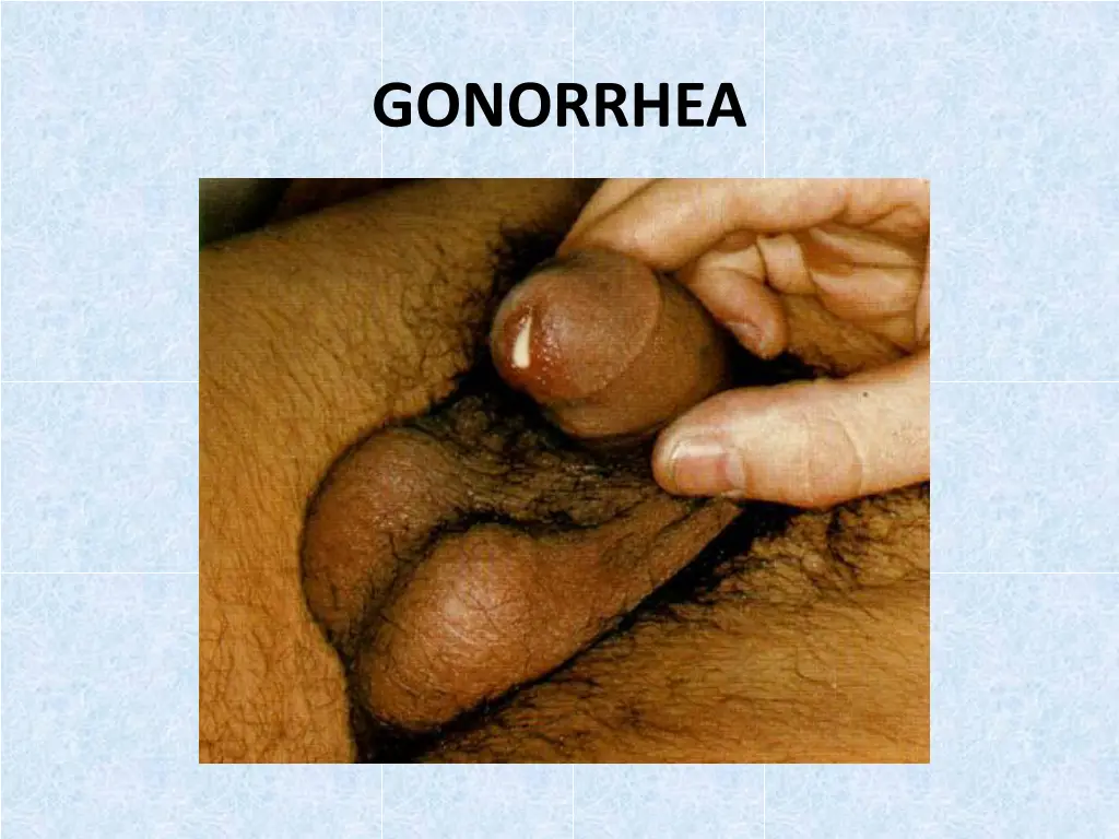 gonorrhea 1