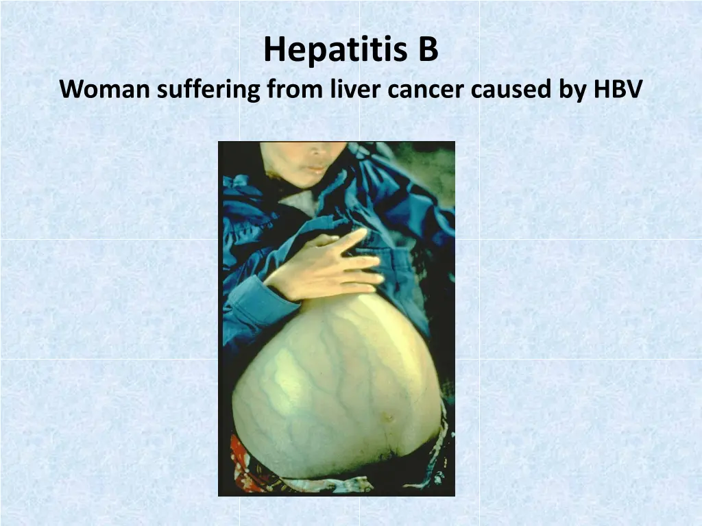 hepatitis b