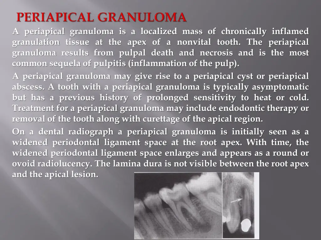 a periapical granuloma is a localized mass