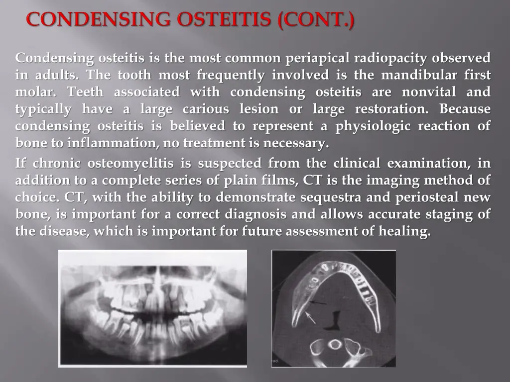 condensing osteitis is the most common periapical