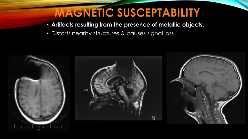 magnetic susceptability artifacts resulting from