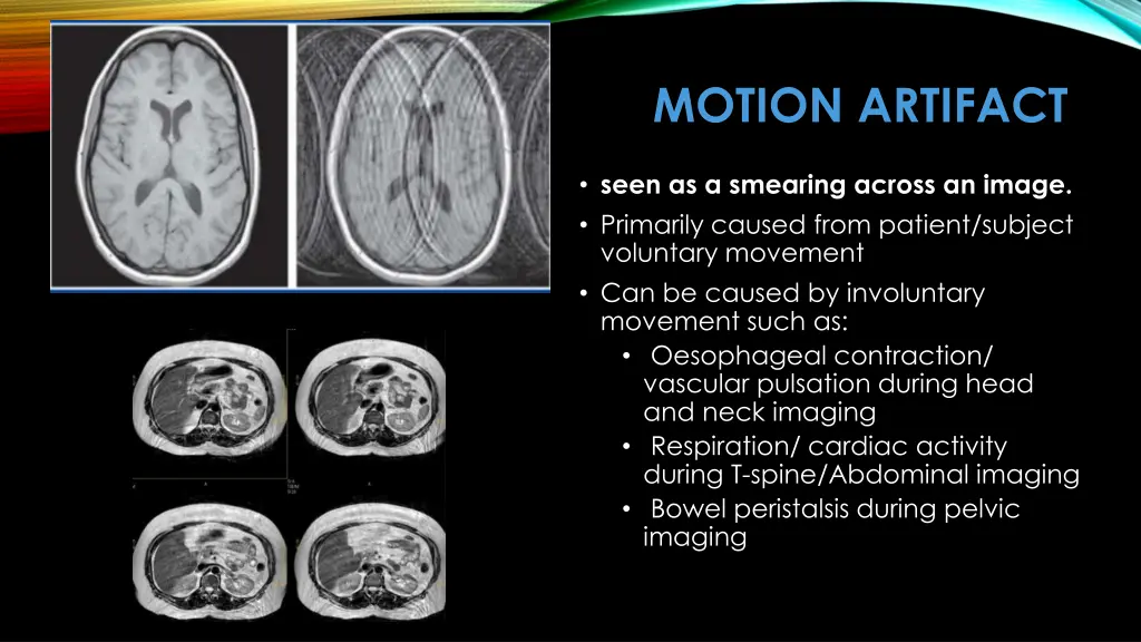 motion artifact