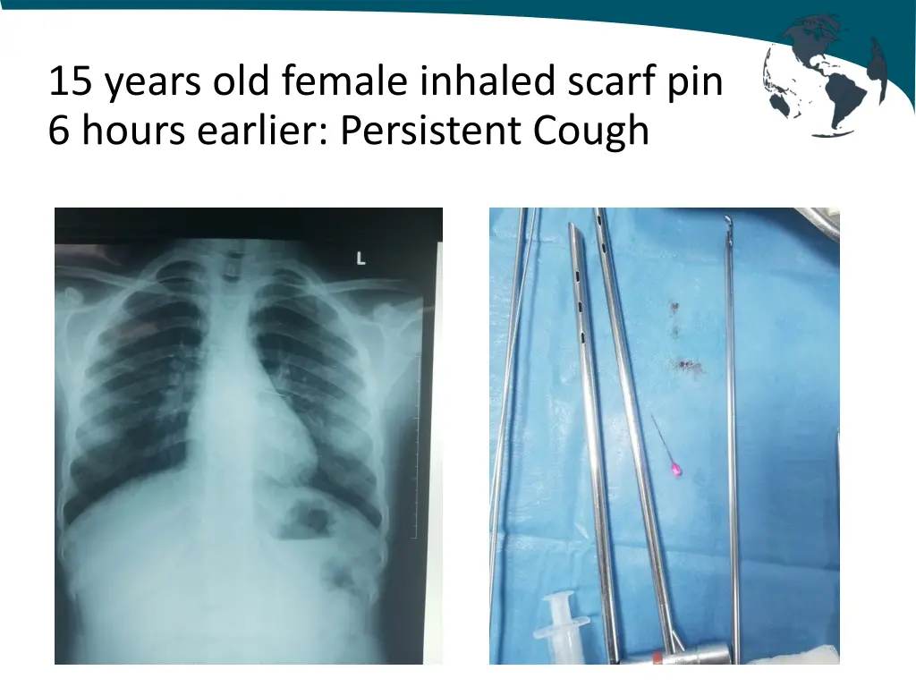 15 years old female inhaled scarf pin 6 hours