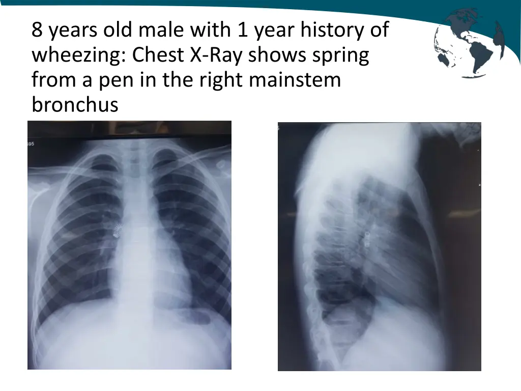 8 years old male with 1 year history of wheezing