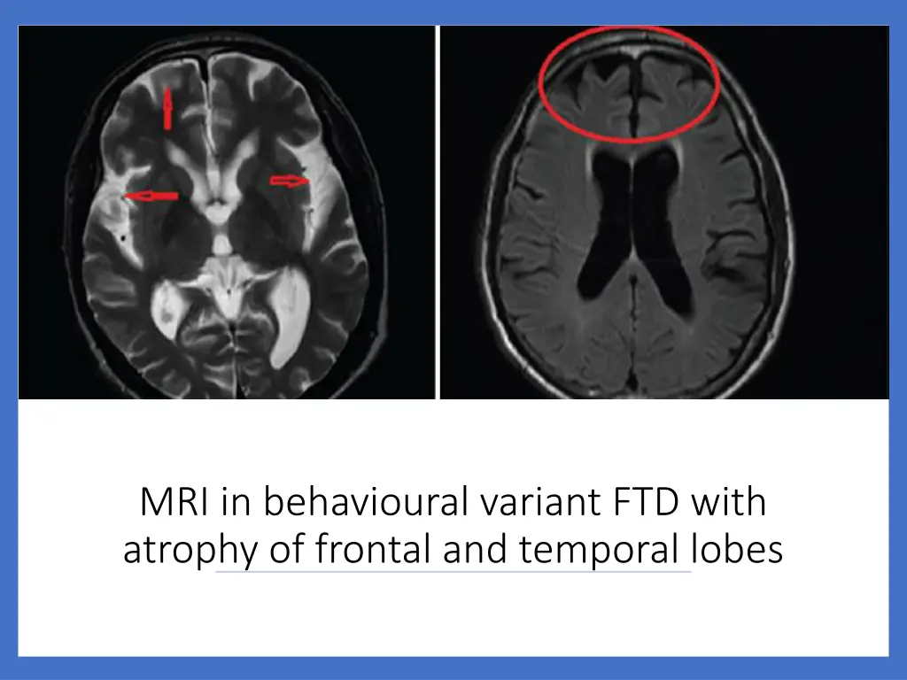 mri in behavioural variant ftd with atrophy