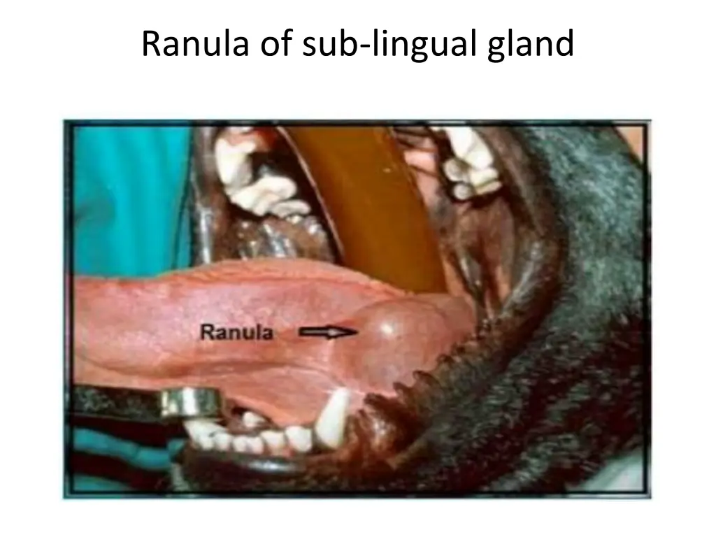 ranula of sub lingual gland