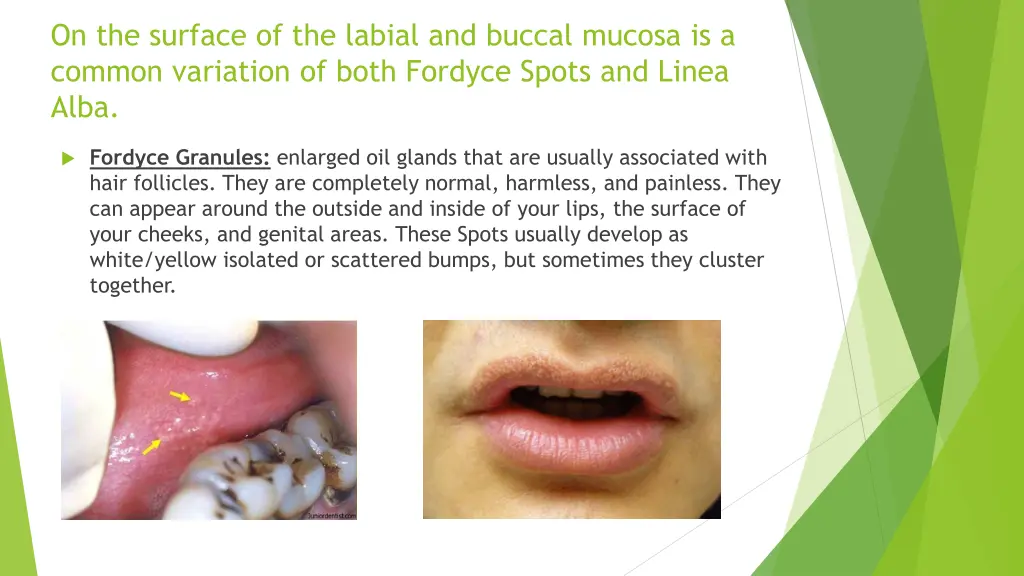 on the surface of the labial and buccal mucosa