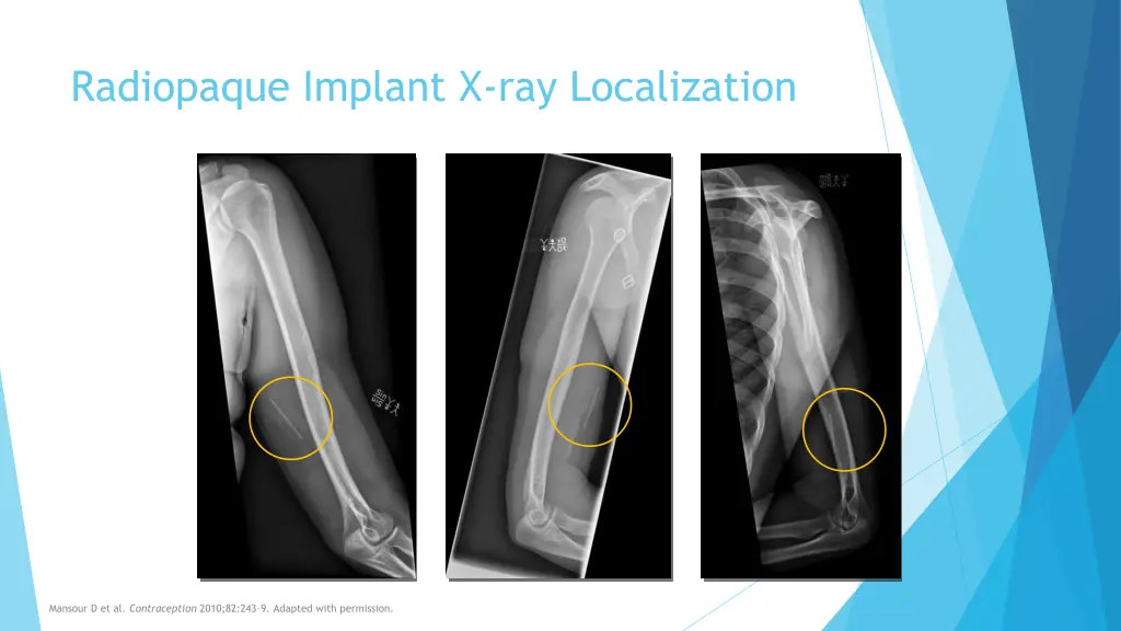 radiopaque implant x ray localization