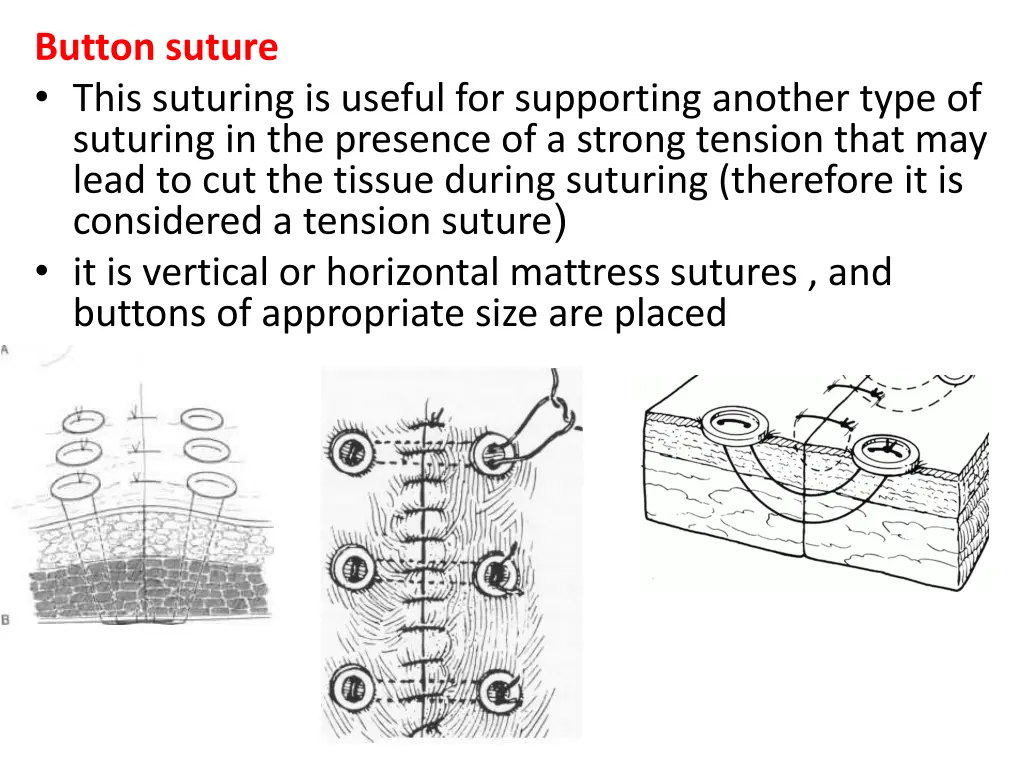 button suture this suturing is useful