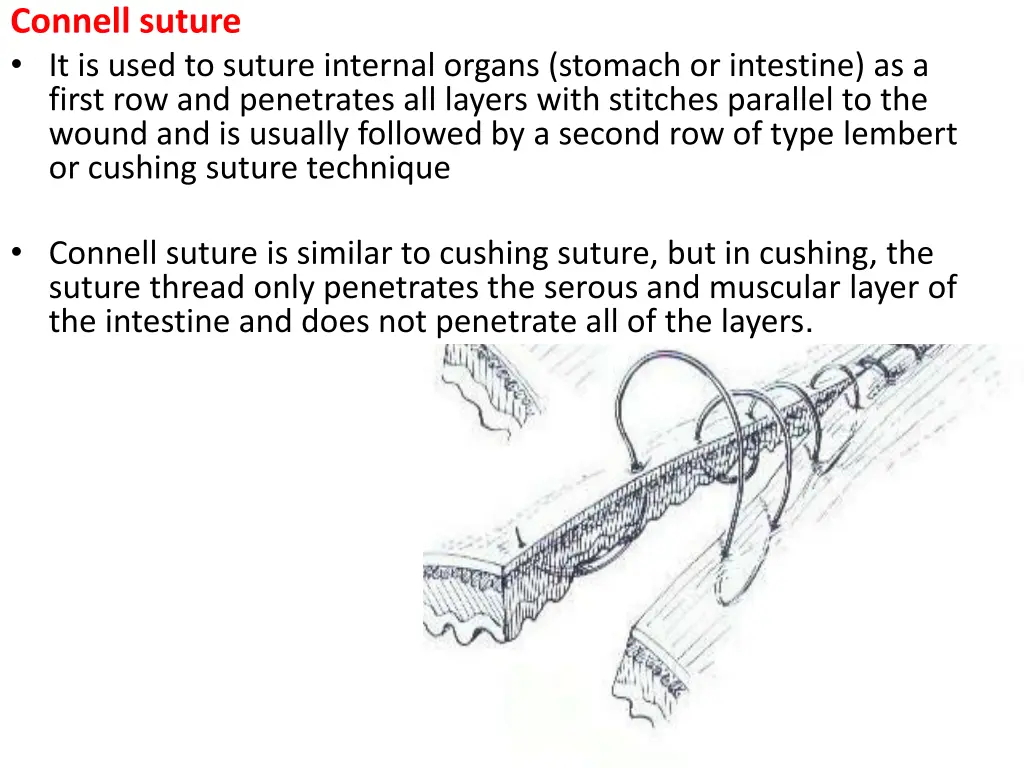 connell suture it is used to suture internal